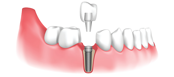 Implant Dentistry